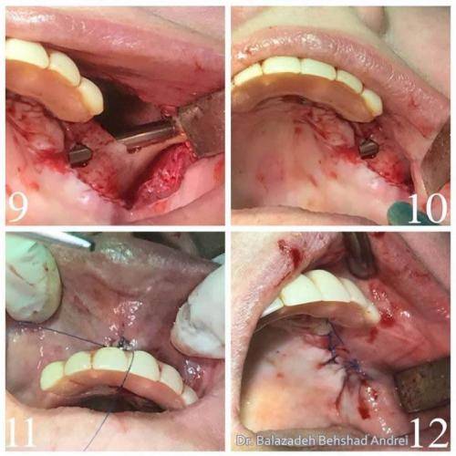 implanturi zigomatice